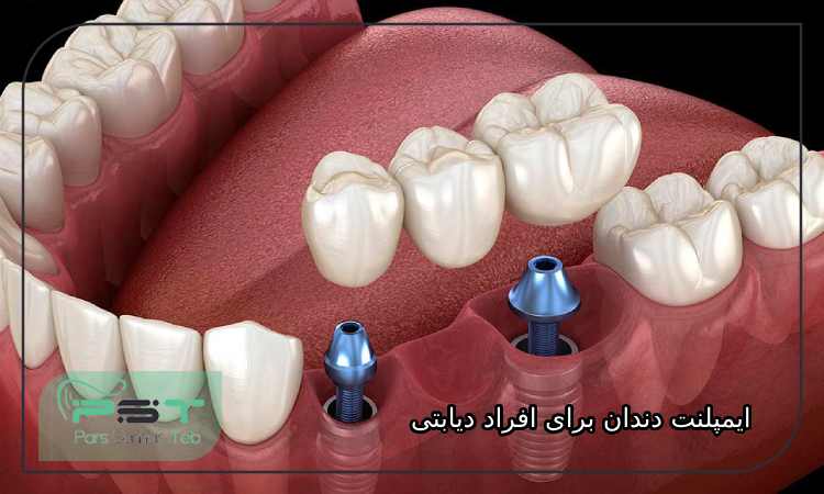 ایمپلنت دندان برای افراد دیابتی ممکن است