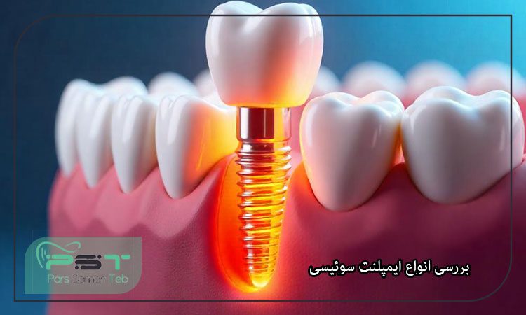 ایمپلنت دندان دیجیتالی