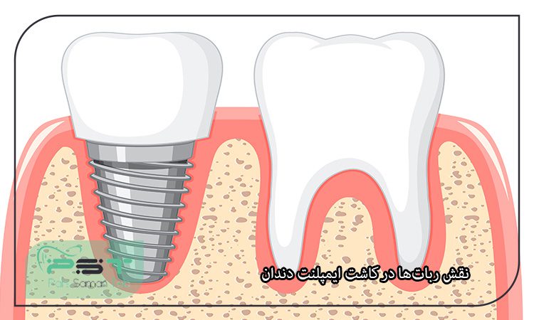 ایمپلنت‌های دندانی و استفاده از تکنولوژی‌های نوین