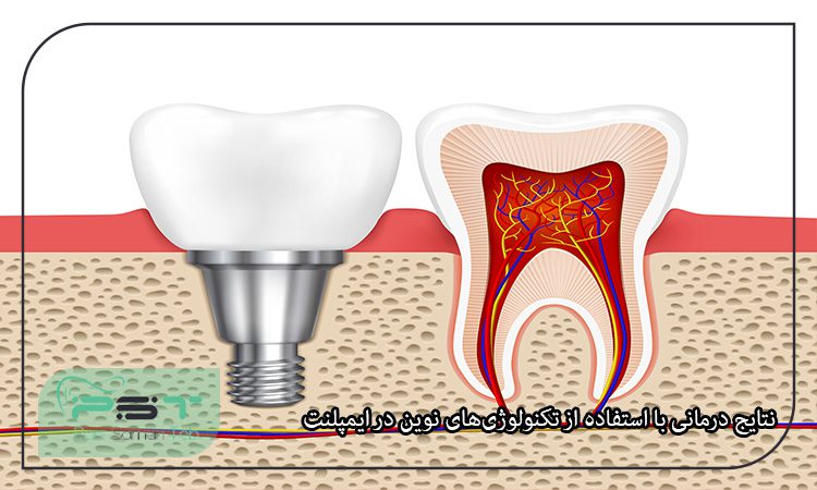 ایمپلنت‌های دندانی و استفاده از تکنولوژی‌های نوین