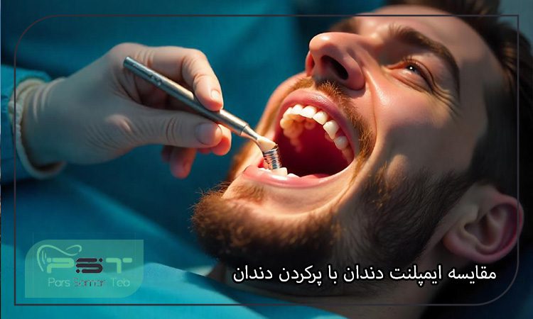 مقایسه ایمپلنت دندان با پرکردن دندان