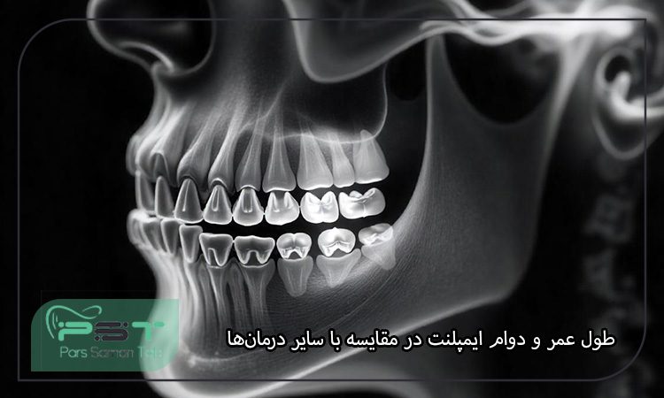 مقایسه ایمپلنت دندان با پرکردن دندان
