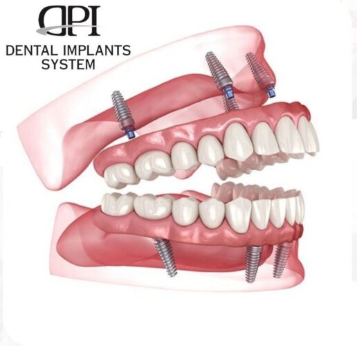 ایمپلنت دندانی برای بیماران قلبی